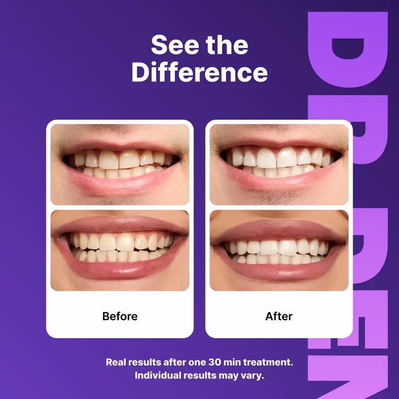 DRDENT Purple Teeth Whitening